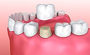 Everything About The Dental Crowns And Their Cost - Article Daisy
