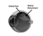 vitreoretinal surgery - Retinasurgeon.uk.com
