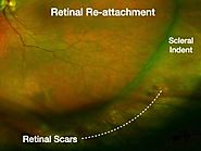 Retinal Detachment Surgery London - Symptoms, Causes & Treatments