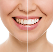 The Benefits of Having a Brighter Smile- Vivid Skin, Hair & Laser Center