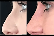 Frequently Asked Questions Regarding Rhinoplasty