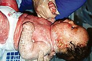 Epidermolytic Ichthyosis