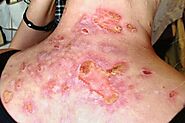 Morgellons Disease