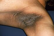 Acanthosis Nigricans