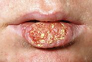 What Is Oral Cancer?