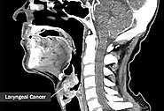 What Is Laryngeal Cancer?
