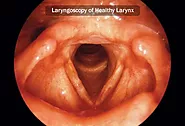 How Doctors Diagnose Laryngeal Cancer