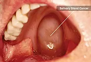What Is Salivary Gland Cancer?