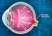 What Is Glaucoma?