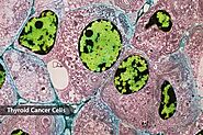 What Is Thyroid Cancer?