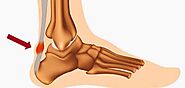 مرض التهاب وتر العرقوب (Achilles Tendinitis)؛ أسبابه وأعراضه وعلاجه