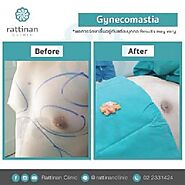 Male Gynecomastia Surgery in Bangkok, Thailand