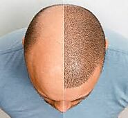 How Much Cost of a Hair Transplant in Dubai? - AtoAllinks