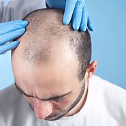 FUE Hair Transplant in Dubai, Abu Dhabi & Sharjah | FUE Cost & Deals