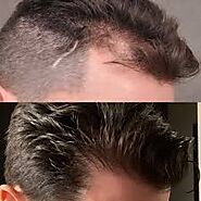 Website at https://dynamic10.bcz.com/2023/01/24/what-are-thetypes-of-hair-transplants/