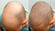 What is the cost of the FUE Hair Transplant in Dubai? – dynamiclinic