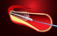 Difference between Coronary angioplasty and stents procedure