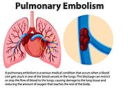 How is pulmonary embolism diagnosed