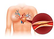 Understanding Angioplasty Surgery And Finding The Best Cardiologist In Hyderabad