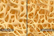 What Is Osteoporosis?