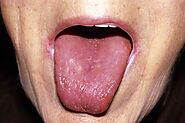 Swollen Tongue