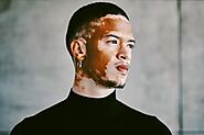 Vitiligo