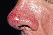 Rosacea