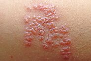 Shingles