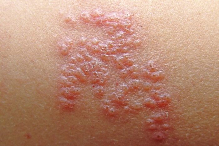 Non-Contagious Skin Conditions To Know | A Listly List