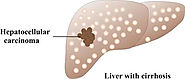 Liver Transplant in India | Transplant Counsellor