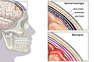 What Is Meningitis?