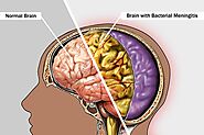 Bacterial Meningitis