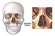 Deviated Septum