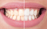 The Best Affordable Teeth Whitening in Auckland