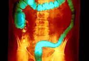 What Is Ulcerative Colitis?