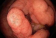 8437231 ulcerative colitis and colon cancer 185px