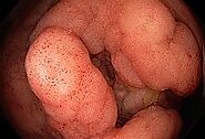 Ulcerative Colitis and Colon Cancer