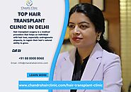 Top Hair Transplant Clinic in Delhi - Chandra Clinic