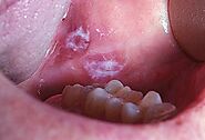 Leukoplakia