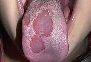 Geographic Tongue