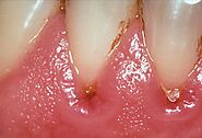 Gum Disease