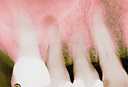 Periodontitis