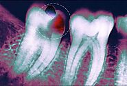 Cavities, Abscesses, Discoloration