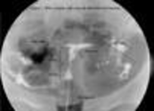 Treating fallopian tube occlu... [Altern Ther Health Med. 2008 Jan-Feb] - PubMed - NCBI