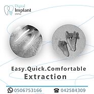 Easy, Quick and Painless Tooth Extraction with Digital Implant Clinic