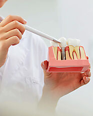 Dental Implants: The Modern Solution for Missing Teeth