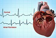 What Is AFib?