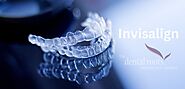 Benefits of Invisalign Aligners - The Dental Roots