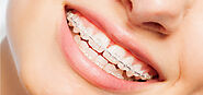 Ceramic Braces: An Alternative to Clear Aligners - The Dental Roots