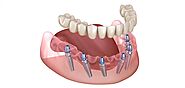 All-on-6 Dental Implants in Gurgaon, South Delhi, India